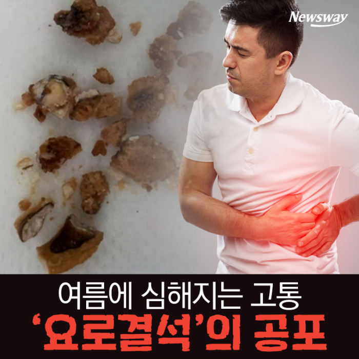 여름에 심해지는 고통···‘요로결석’의 공포 기사의 사진