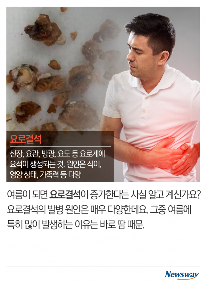 여름에 심해지는 고통···‘요로결석’의 공포 기사의 사진