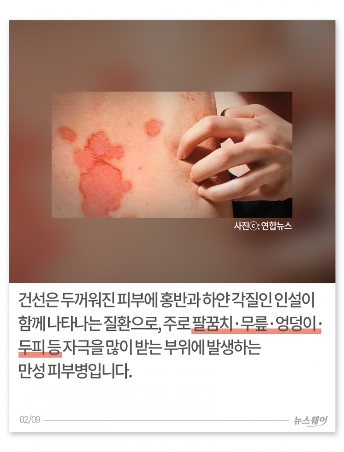환절기 거칠고 빨갛고 가려운 내 몸, 왜 이래? 기사의 사진