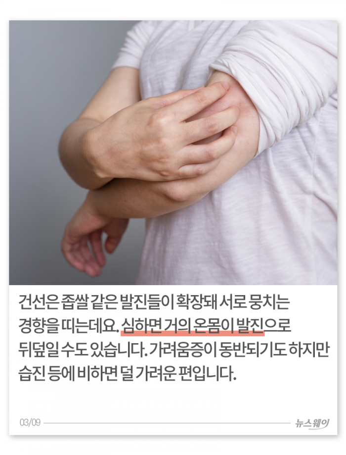 환절기 거칠고 빨갛고 가려운 내 몸, 왜 이래? 기사의 사진