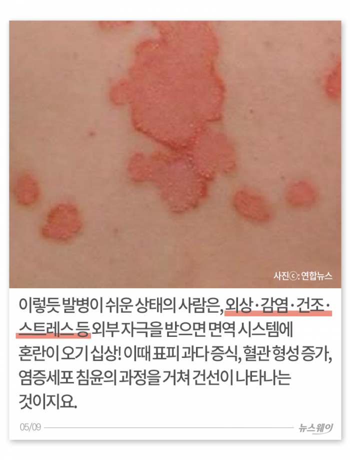 환절기 거칠고 빨갛고 가려운 내 몸, 왜 이래? 기사의 사진