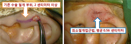 기존 수술법으로 수술 받은 환자의 귀(좌)와 최소절개접근법으로 전이개낭종 제거술을 받은 환자의 귀(우)