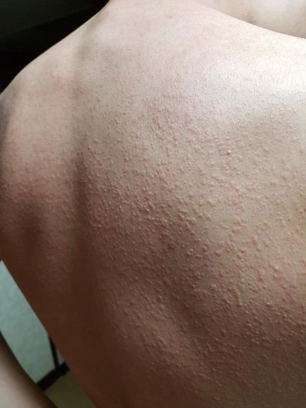 한림대동탄성심병원 최정희 교수, 콜린성두드러기서 오말리주맙 치료효과 SCI논문 게재