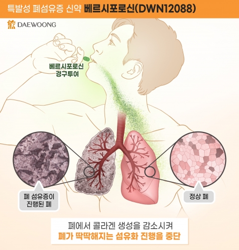 대웅제약 '특발성폐섬유증 신약', 유럽 희귀의약품 지정