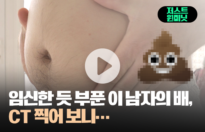 임신한 듯 부푼 이 남자의 배, CT 찍어 보니··· 기사의 사진